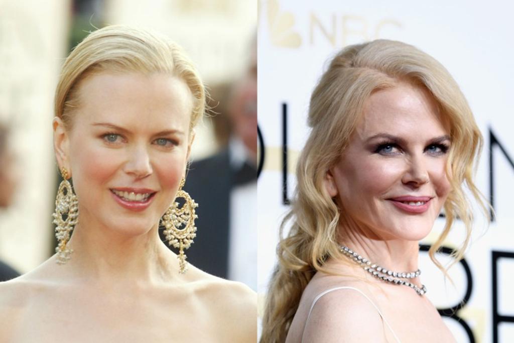 Nicole Kidman, Botox, Beauty