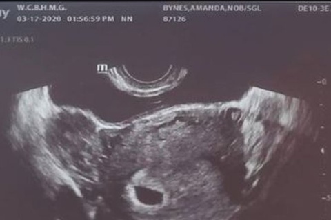 amanda bynes pregnancy announcement