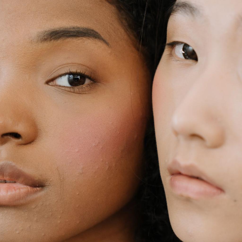acne breakout skincare treatment